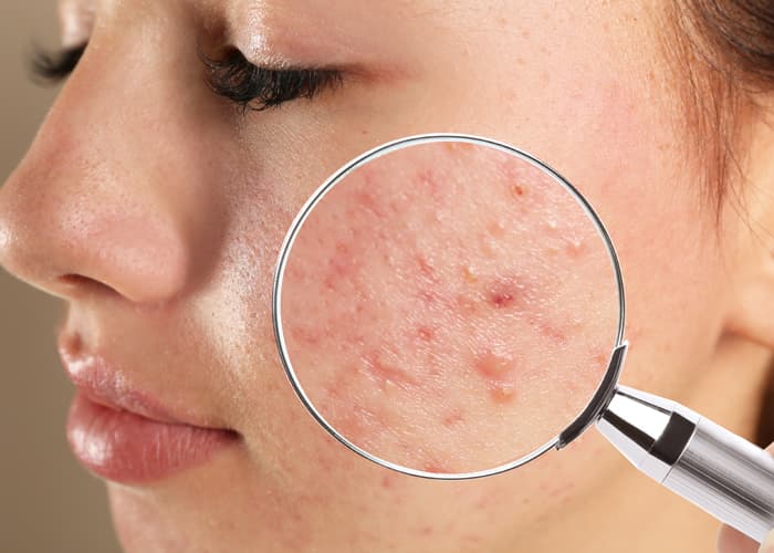 When To See A Dermatologist For Pimples
