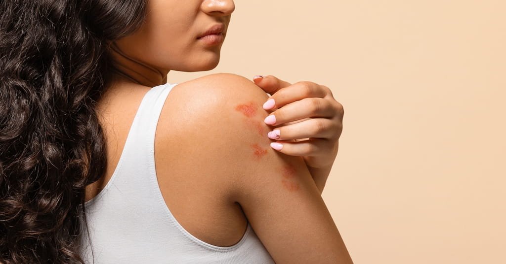 Calamine Lotion For Skin Rashes