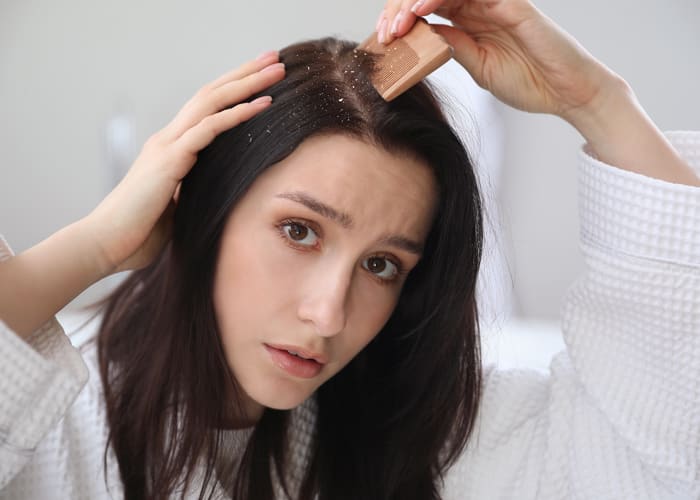 Dandruff