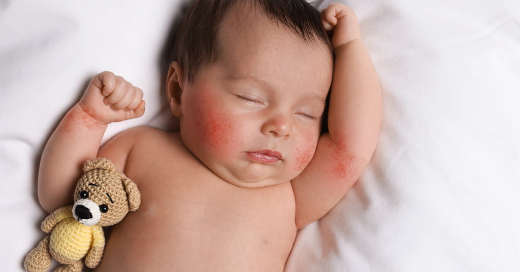 What Are The Different Types Of Skin Rashes In Children