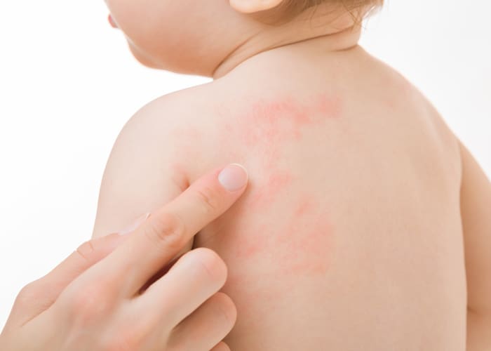 When Should I Worry About Rash On My Baby