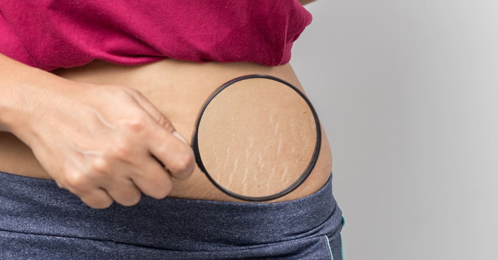 What Is The Truth About Stretch Marks