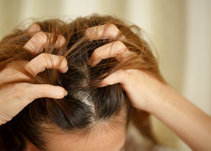 Scalp Psoriasis Risk