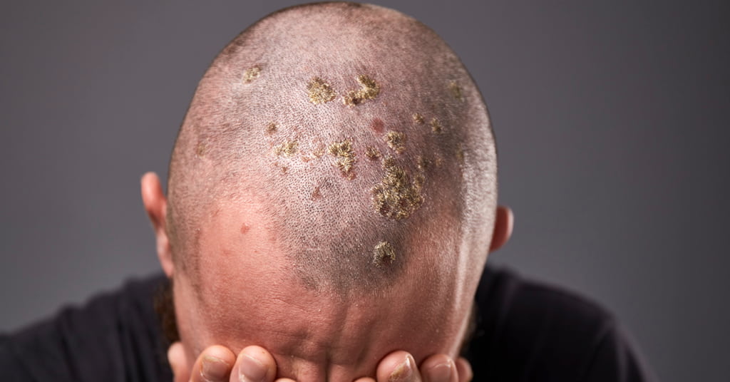 Scalp Psoriasis