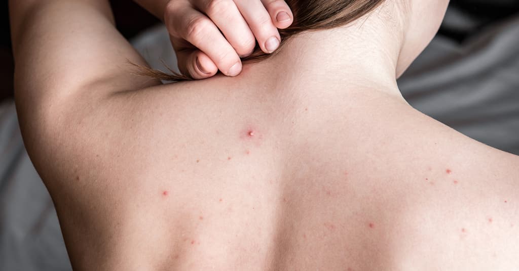 'Bills Mafia House' sold for $810,000 | Watch - MSN - Best Way To Clear Acne On Face