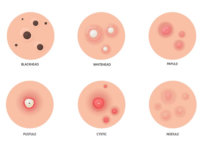Types of Back Acne You Might See