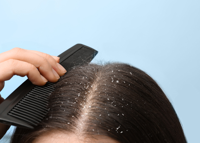 Scalp Detox for Dandruff