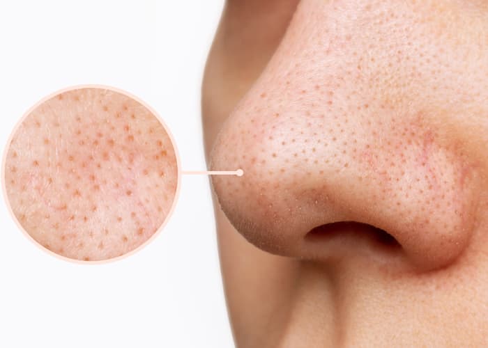 Understanding Open Pores A Skin Perspective